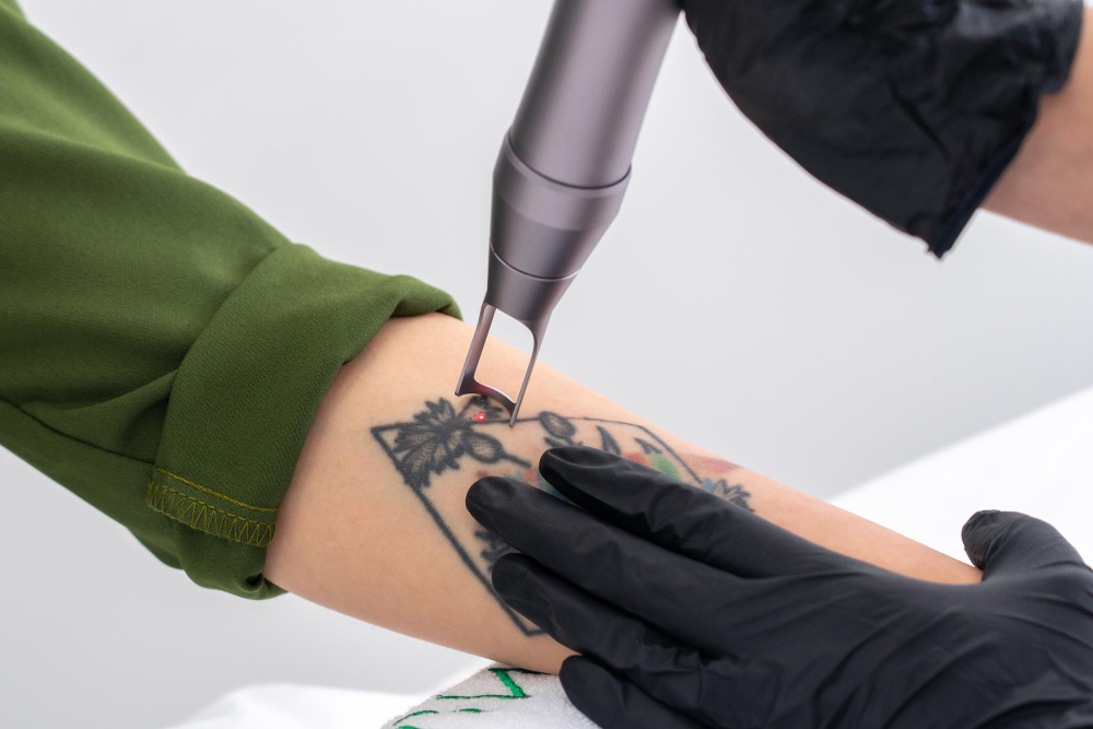 Ways to Remove Unwanted Tattoo